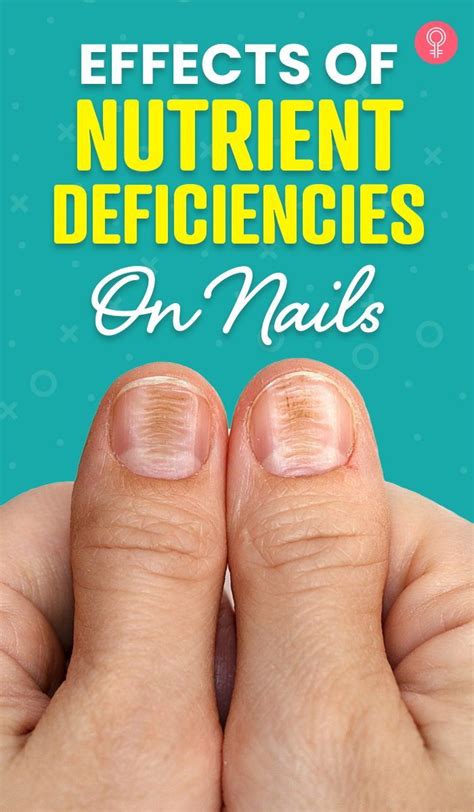 Nutritional Deficiencies and Split Nails: The Connection