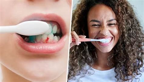 Oral Care Practices and Bleeding Gums