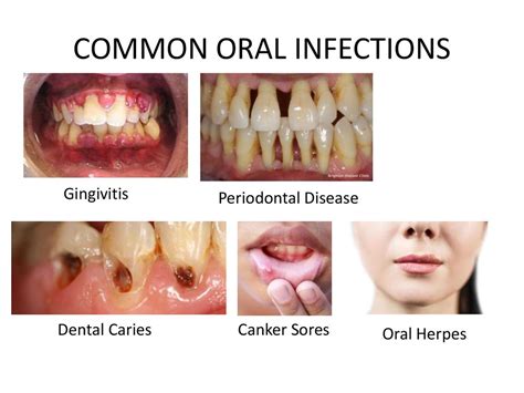 Oral Infections: A Common Culprit