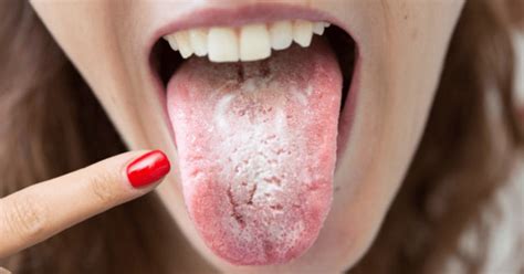 Oral Thrush: A Fungal Infection to Consider