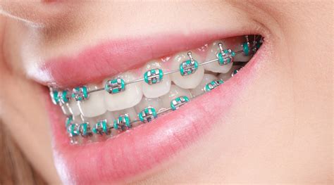 Orthodontic Treatment: Traditional Braces