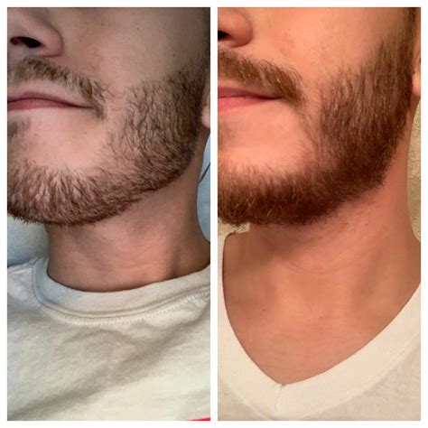 Overcoming Patchy Facial Hair: A Guide to Fulfilling Your Facial Hair Goals!