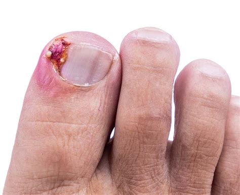 Painful Symptoms and Complications of Ingrown Toenails