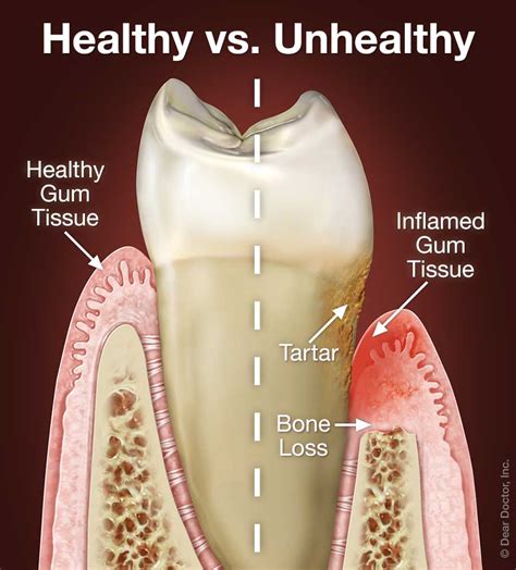 Periodontal Disease: A Leading Culprit Behind Weakened Gum Tissue