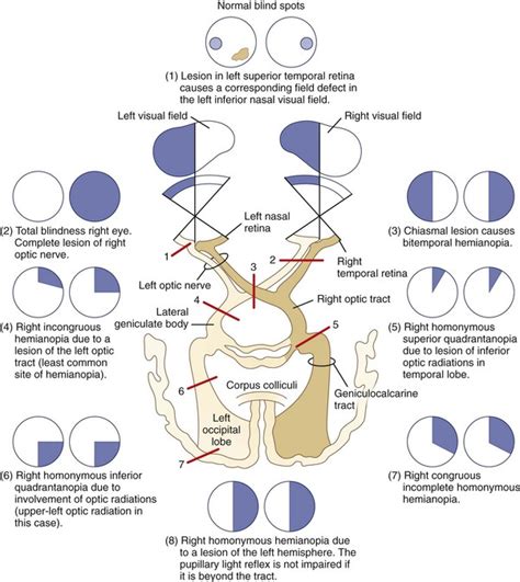 Physical and Psychological Triggers of Dreams Involving the Loss of Vision in the Right Eye