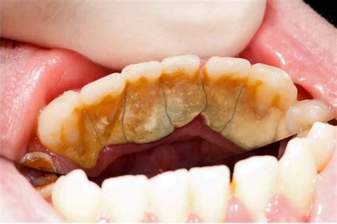 Plaque, Tartar, and Cavities: Understanding Common Dental Problems