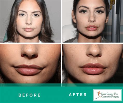 Popular Cosmetic Procedures for Plumper Lips: Lip Fillers and Lip Implants