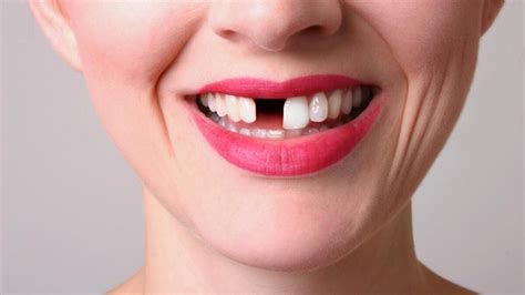 Possible Causes for Repeated Dreams about Tooth Loss