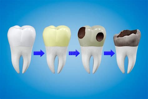 Possible Factors Contributing to Dreams of Dental Deterioration