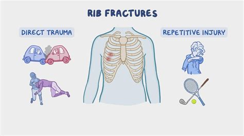 Possible Physical Factors Associated with Dreaming about Rib Injuries