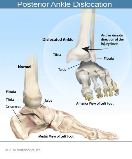 Possible Symbolism of an Enlarged Ankle in Dreamscapes