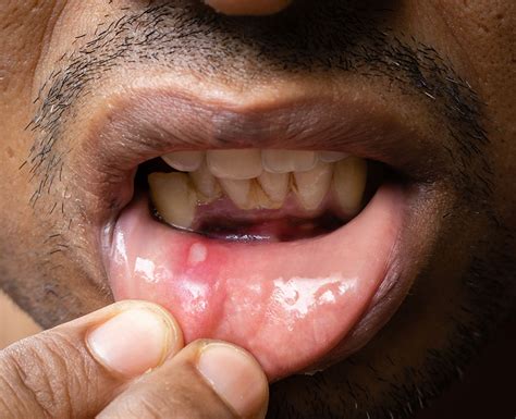 Possible Triggers of Oral Lesions