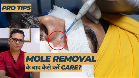 Post-Mole Removal Care: Ensuring Optimal Healing