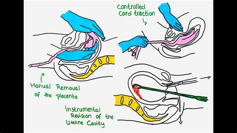 Preparing for the Removal of the Uterus: Essential Information