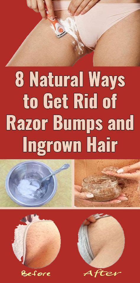 Prevent Ingrown Hairs and Razor Bumps