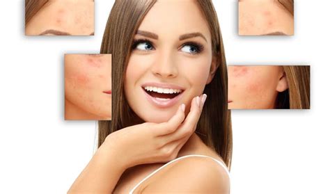 Preventing Acne Scars: Tips for Minimizing their Appearance