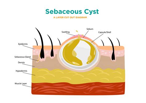 Preventing Formation of Cysts in the Dorsal Region