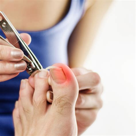 Preventing Ingrown Toenails: Tips for Proper Foot Care