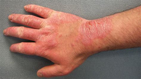 Preventing Rashes: Hand Care and Hygiene Tips