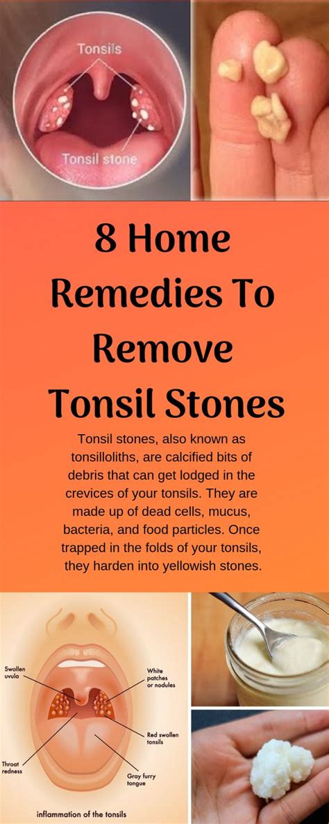 Preventing the Formation of Tonsil Deposits