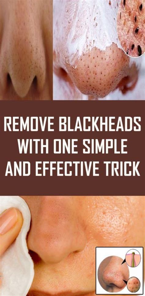 Prevention is Key: Maintaining Blackhead-Free Skin