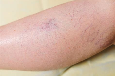 Prevention is Key: Making Lifestyle Changes to Minimize the Risk of Spider Veins