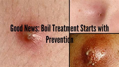 Prevention is Key: Tips for Avoiding Formation of Boils