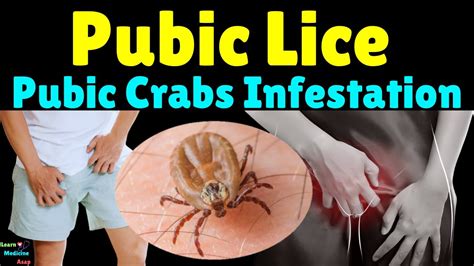 Preventive Measures: How to Avoid Infestation by Pubic Lice