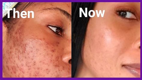 Professional Treatments for Severe Acne Breakouts