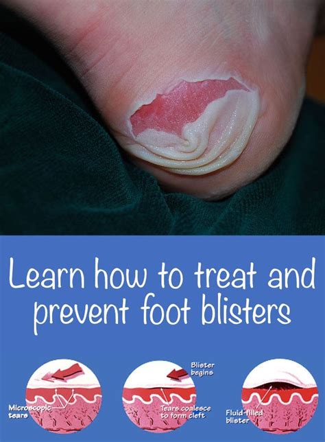 Proper Foot Blister Care: Essential Tips for Treatment and Prevention