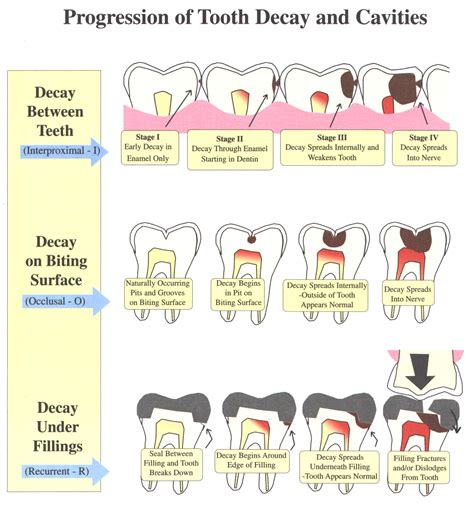 Psychological Explanations for Dreams of Decayed Teeth