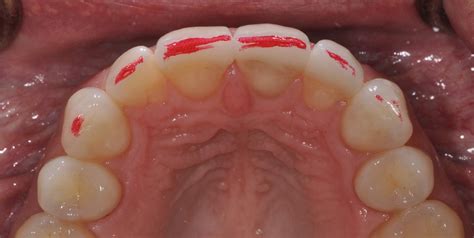 Psychological Interpretation: Decoding the Meaning Behind a Damaged Front Incisor