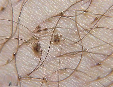 Pubic Lice: An Unwanted Intrusion into Your Dream World