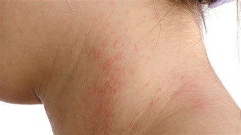 Recognizing Rash Symptoms