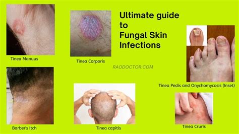 Recognizing When to Seek Medical Attention for Your Fungal Infection