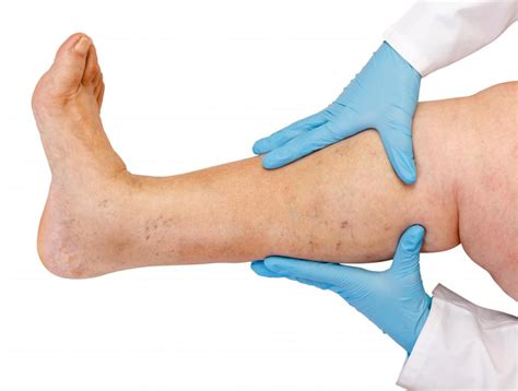 Recognizing When to Seek Professional Assistance for Leg Swelling