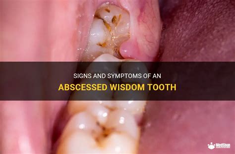 Recognizing the Early Warning Signs of an Abscess