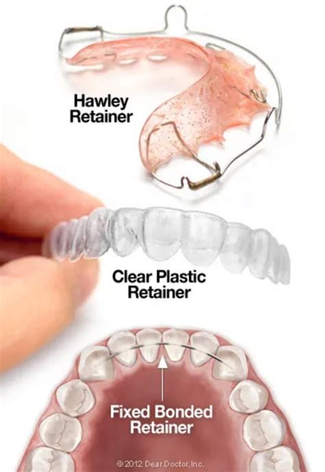 Recognizing the Significance of a Retainer