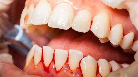 Recognizing the Signs of Gum Bleeding