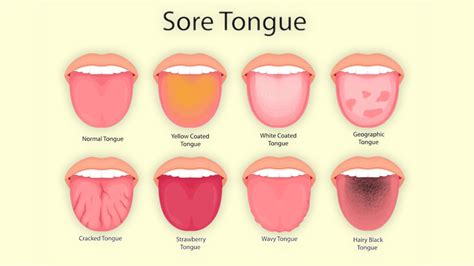 Recognizing the Signs of a Tongue Infection