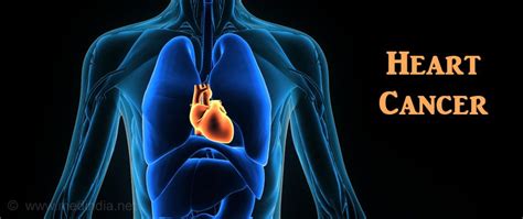 Recognizing the Subtle Symptoms of Cardiac Tumor