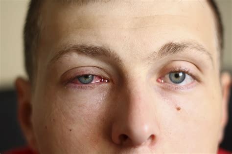 Recognizing the Symptoms: How to Identify a Swollen Eye