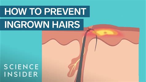 Recognizing the Symptoms of Ingrown Hair