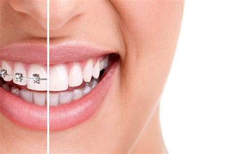 Say Farewell to Metal: Exploring Alternative Options for Orthodontic Treatment