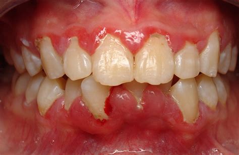 Seeking Professional Help: How Dentists Diagnose Gum Infections