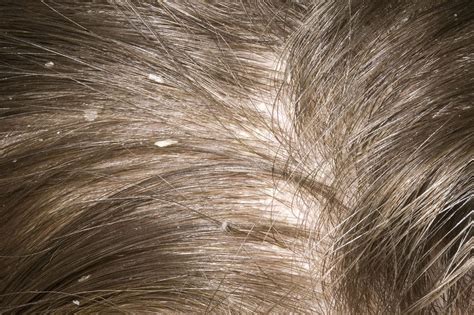 Seeking Professional Help: Medical Treatments for Severe Dandruff Cases