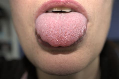 Seeking Professional Help: When to Consult a Doctor about Dreams Involving Enlarged Tongue