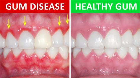 Signs and Symptoms of Poor Gum Health