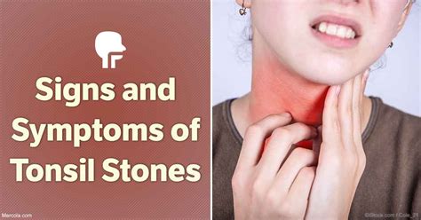 Signs and Symptoms of Tonsil Stones