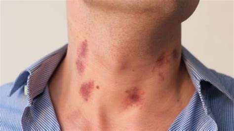 Signs of Passion or Betrayal? Examining the Relationship Dynamics Reflected in Dreamed Hickeys